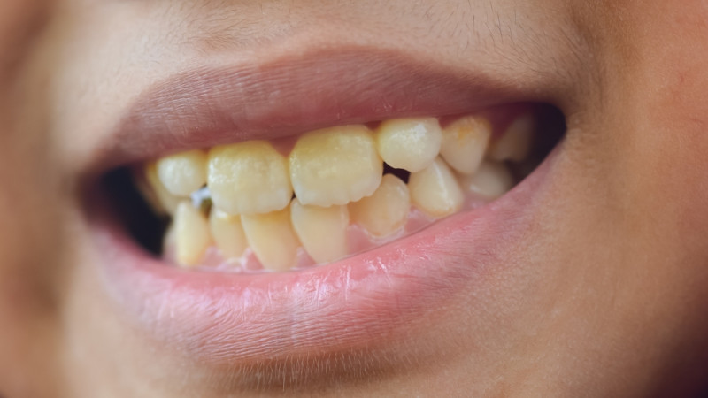 Dents jaunes : quelles solutions ?
