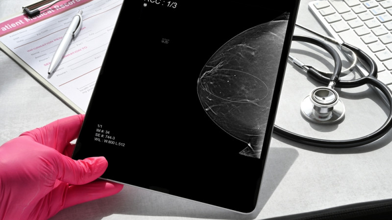 Est-ce qu'un cancer du sein se voit à la mammographie ?