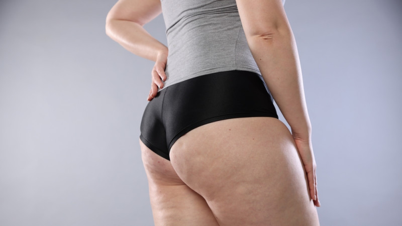 Pourquoi les femmes ont de la cellulite... et pas les hommes ?