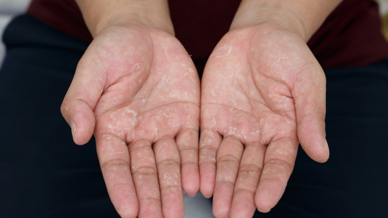 Tout savoir sur la dyshidrose