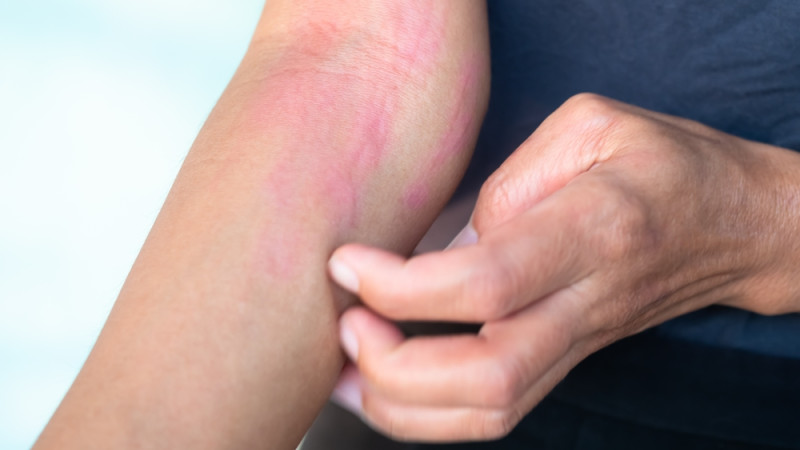 Est-ce que le stress peut causer de l’urticaire ?
