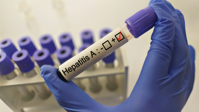 Tout savoir sur l’hépatite A