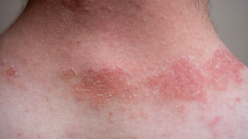 Comment distinguer eczéma et urticaire ?