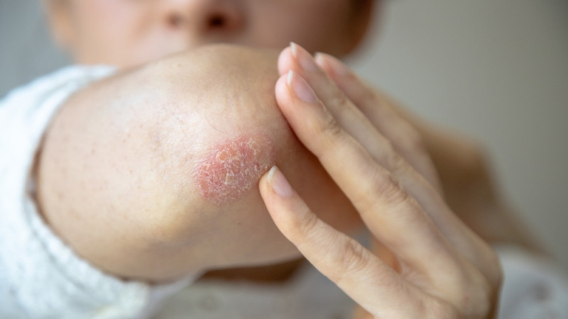 personne avec eczéma 