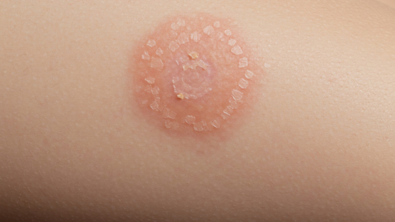 Teigne : quels sont les premiers symptômes ?