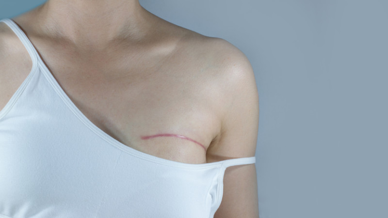 Tout savoir sur la mastectomie