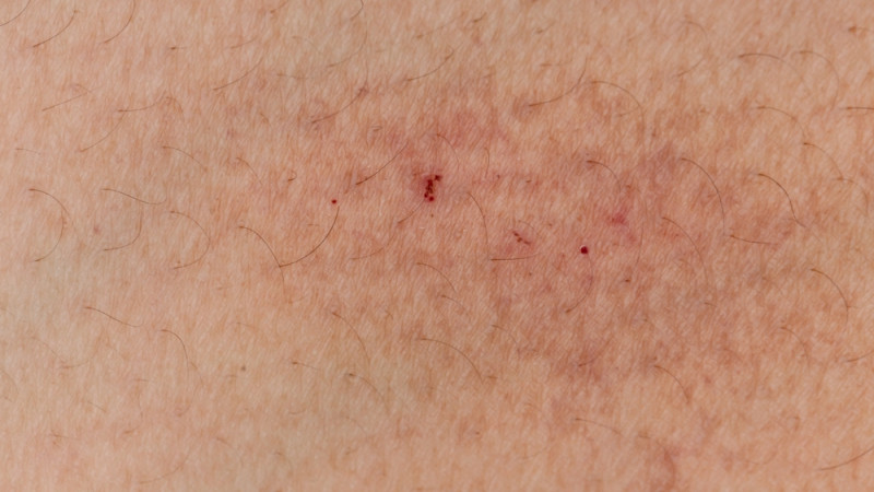 Comment se débarrasser d’un poil incarné ?