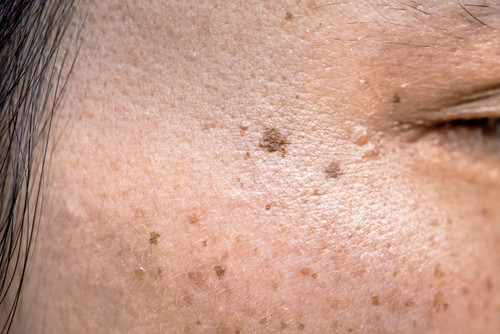 Lentigo : ces taches brunes qui interpellent la peau