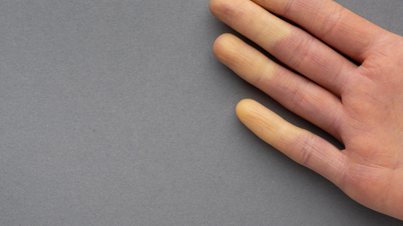 syndrome de raynaud