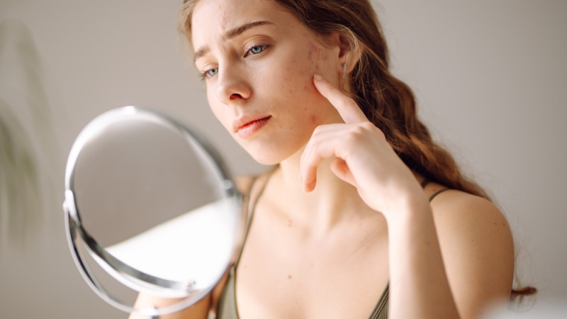 jeune femme avec acné