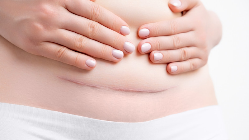 Comment se remettre d’une césarienne ?