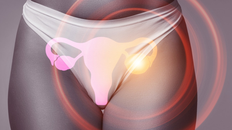 Quels sont les symptômes d’un kyste de l’ovaire ?