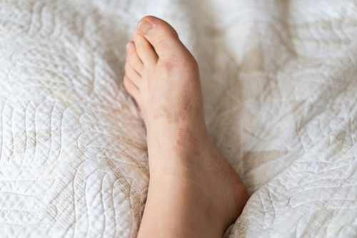 Le granulome : un réaction inflammatoire bénigne ?