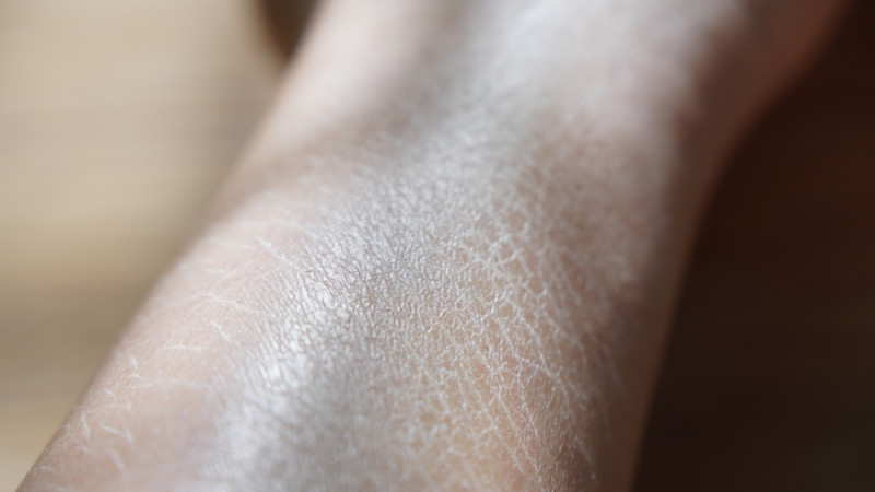 Comment en finir avec la peau de crocodile ?