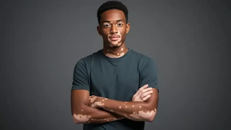 Tout savoir sur le piébaldisme : une particularité génétique qui se voit dès la naissance