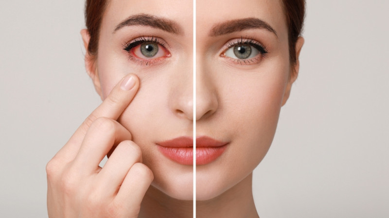 Comment calmer une conjonctivite ?