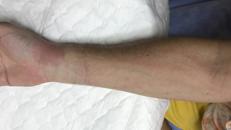 Tout savoir sur la lymphangite