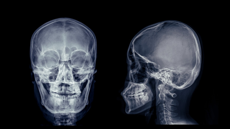 Fracture du rocher : symptômes et risques