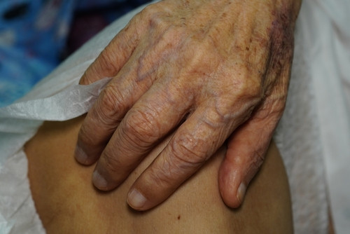 Maladie de Cadasil : quels sont les symptômes, quelle espérance de vie ?