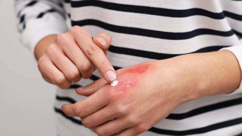 femme applique une crème sur sa cicatrice 
