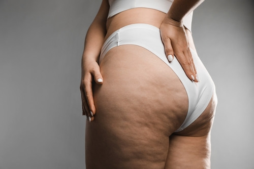 10 actions anti-cellulite redoutables pour lisser la peau