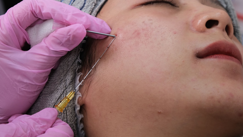 Gros plan d'un traitement du visage avec une procédure de microneedling en milieu clinique.